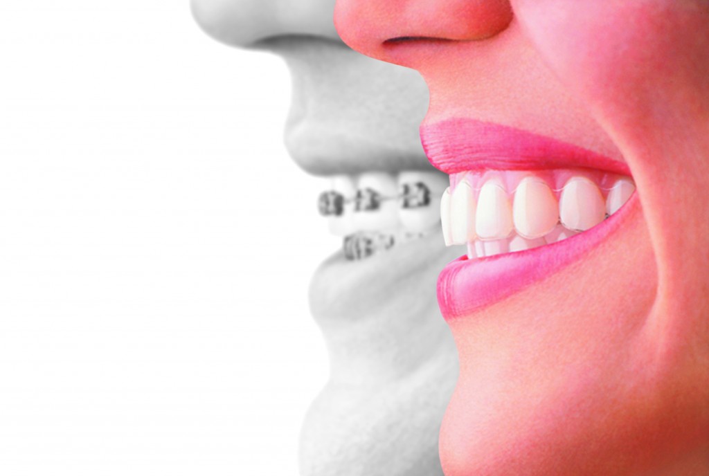 braces, orthodontist, kid braces, invisalign, teeth, clear braces, about braces, dental braces, invisalign pictures, invisible braces, children's braces, orthodontic braces, invisalign results, traditional braces, teeth braces, what is invisalign, #InvisalignTalk
